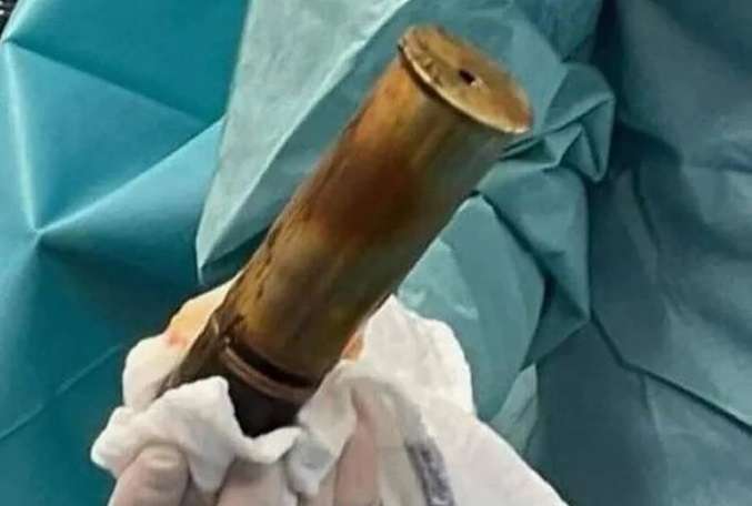 ΠΑΝΙΚΟΣ ΣΕ ΝΟΣΟΚΟΜΕΙΟ ΜΕ ΗΛΙΚΙΩΜΕΝΟ ΠΟΥ ΕΙΧΕ ΣΦΗΝΩΜΕΝΗ ΟΒΙΔΑ ΣΤΟΝ ΠΡΩΚΤΟ!!!!