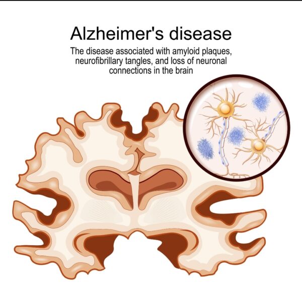Φάρμακο για την επιληψία σταματά τη νόσο Αλτσχάιμερ πριν ξεκινήσει