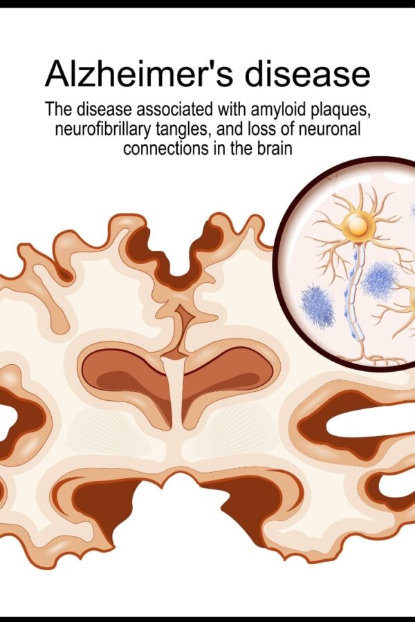 Φάρμακο για την επιληψία σταματά τη νόσο Αλτσχάιμερ πριν ξεκινήσει