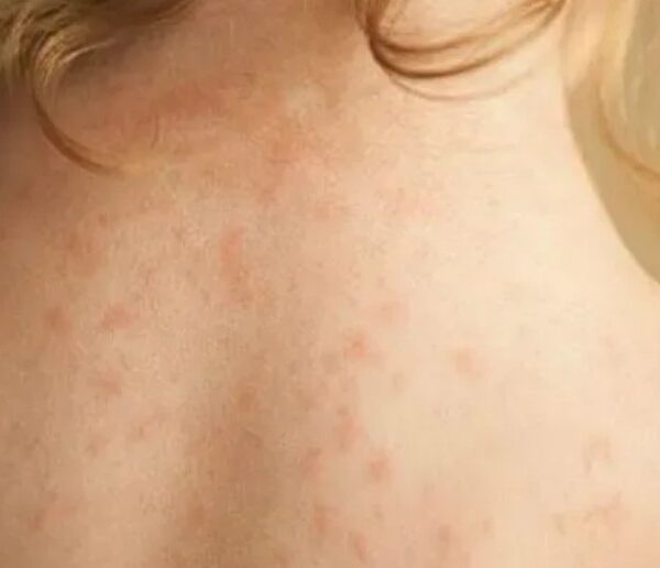 Βρετανία: «Πρωτοφανές» ξέσπασμα μηνιγγίτιδας – Δύο φοιτητές νεκροί