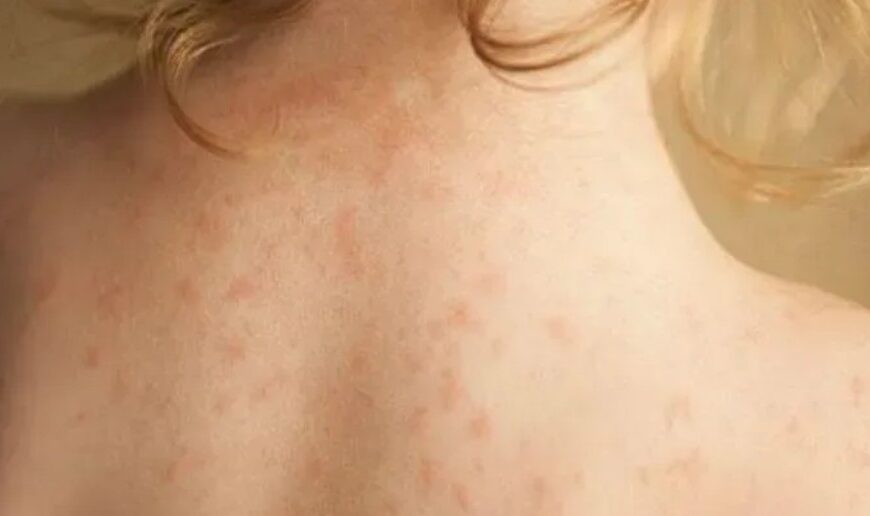 Βρετανία: «Πρωτοφανές» ξέσπασμα μηνιγγίτιδας – Δύο φοιτητές νεκροί