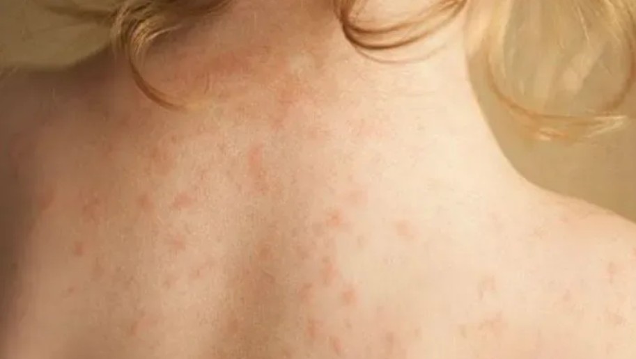 Βρετανία: «Πρωτοφανές» ξέσπασμα μηνιγγίτιδας – Δύο φοιτητές νεκροί